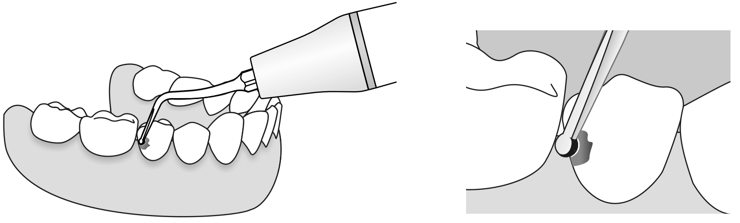 Сфера применения наконечника для скалера